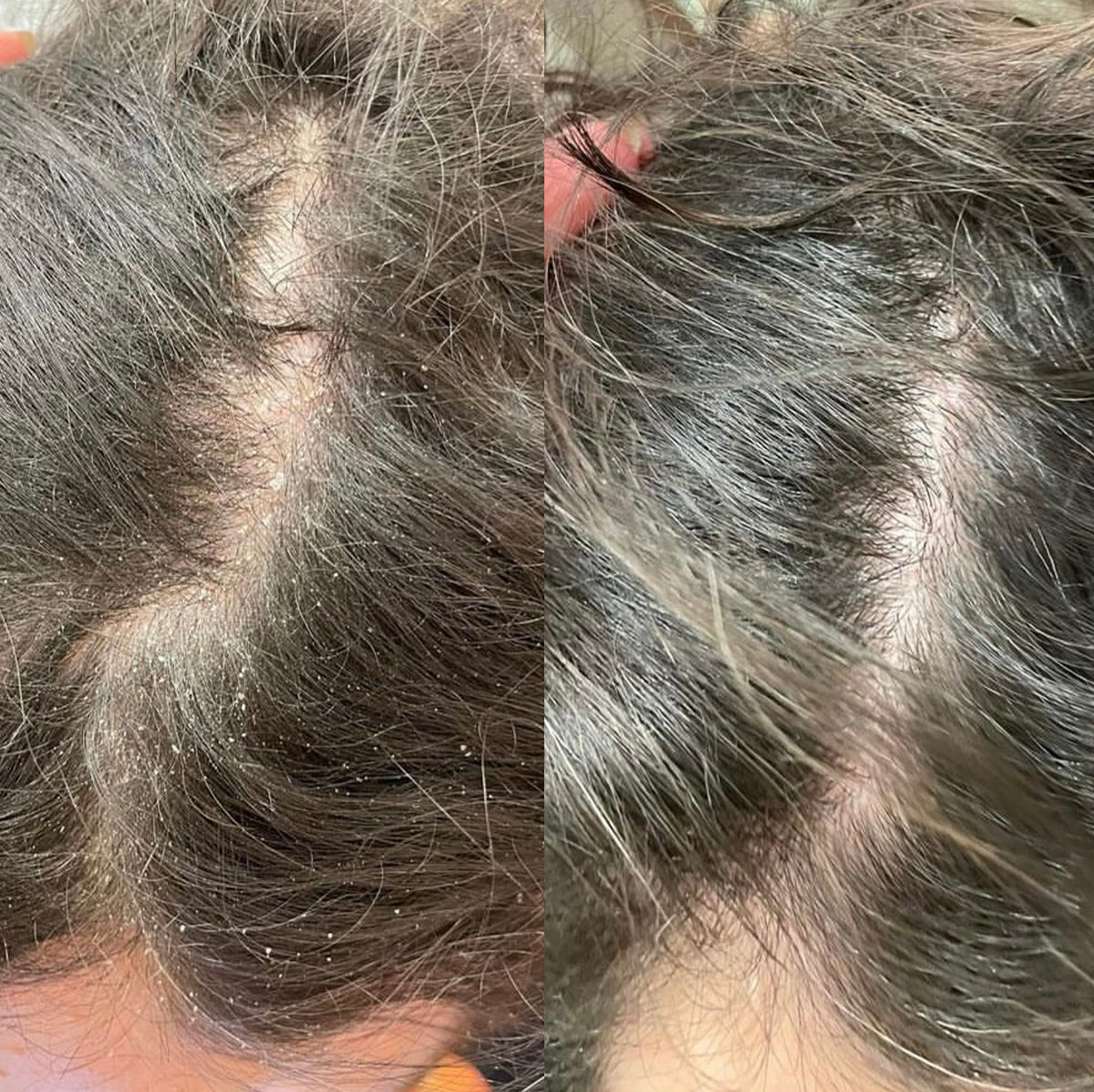 Scalp Mask